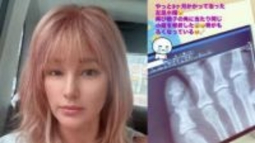 【 梅宮アンナ 】　乳がん闘病中に悲痛な報告…左足小指を再び骨折「骨がもろくなっている」治療の副作用への不安も吐露