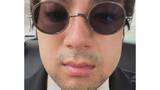 「【 山田裕貴 】　親知らず抜歯で“ふにゃふにゃ声”の緊急事態　頬が腫れた自撮り公開にファン「お大事に」「無事に舞台挨拶できますように」」の画像1