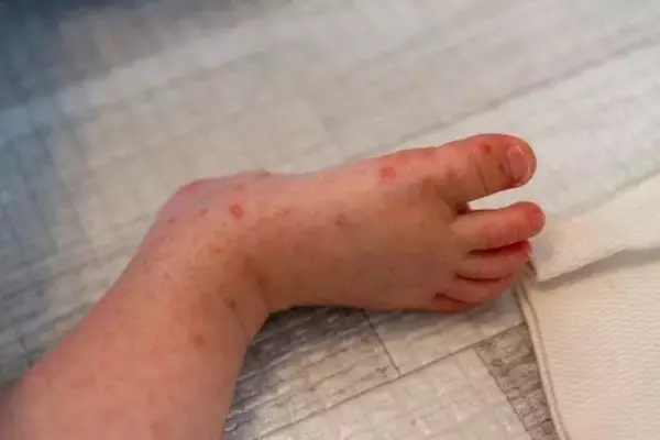 大人も危険!?今年は警報レベル”手足口病” 痛がる子どもへの対策＆予防法を解説