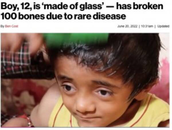 ガラスのような骨で100か所以上の骨折、身体中が折れ曲がった12歳少年（印）＜動画あり＞