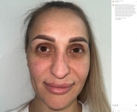 トルコで美容整形した女性、スーパーモデルのような顔に「変わりすぎて怖い」「新しいパスポートが必要」の声
