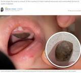 「「上あごに腫瘍」と診断された男児、別の病院で“蓮の実の殻”と判明し両親憤慨（中国）」の画像1