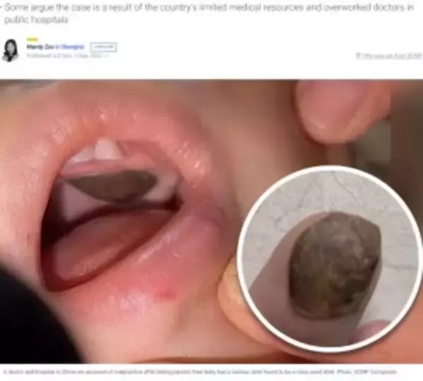 「上あごに腫瘍」と診断された男児、別の病院で“蓮の実の殻”と判明し両親憤慨（中国）