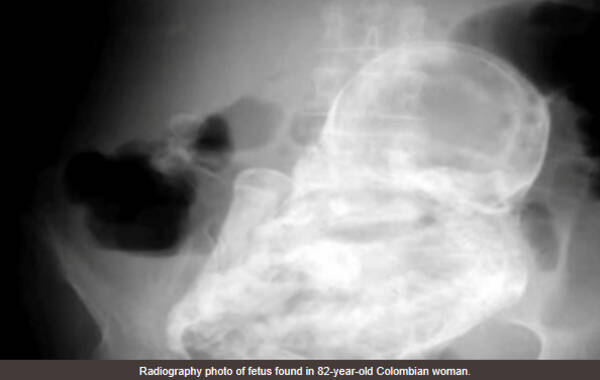 レントゲン検査で判明 歳女性の腹部に40年前に妊娠した大きな胎児 コロンビア 13年12月14日 エキサイトニュース
