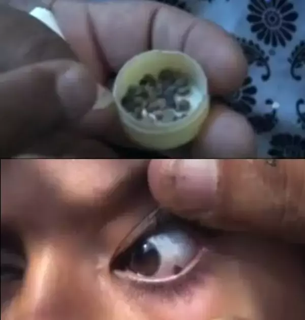 涙の代わりに目から「小石」が出るイエメンの12歳少女。＜動画あり＞