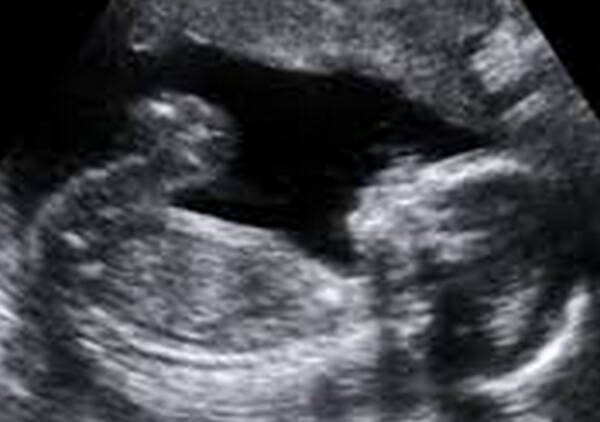 胎児死亡診断の宣告を受けた妊婦 中絶処置を拒否し 別の病院で無事出産 英 2014年3月6日 エキサイトニュース
