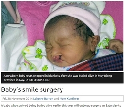 口唇口蓋裂ゆえ父親に生き埋めにされた赤ちゃん。救出後、医師が無償で整形手術。（カンボジア）