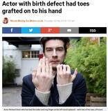 「先天性の手指欠損を克服　イケメン舞台俳優として生きる英28歳」の画像1