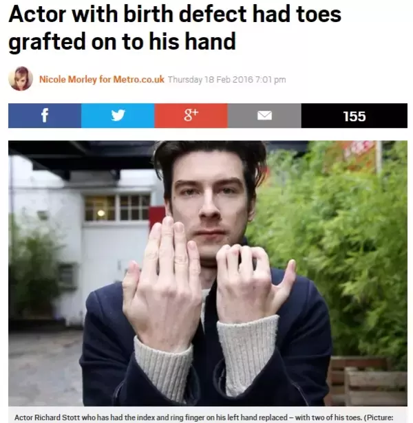 「先天性の手指欠損を克服　イケメン舞台俳優として生きる英28歳」の画像