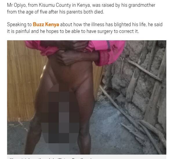 ヒザ下まで垂れた巨大陰茎を持つ男性 苦痛でしかない ケニア 16年9月9日 エキサイトニュース