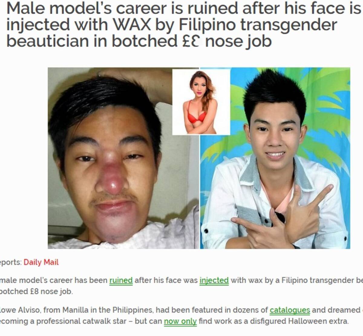 鼻と顎の美容整形に大失敗 イケメンモデルのキャリアが台無しに フィリピン 16年9月10日 エキサイトニュース