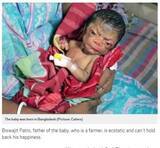 「4百万人に1人　早老症の赤ちゃんが誕生　両親「神に感謝して、ありのままの姿を受け止めたい」（バングラデシュ）」の画像1