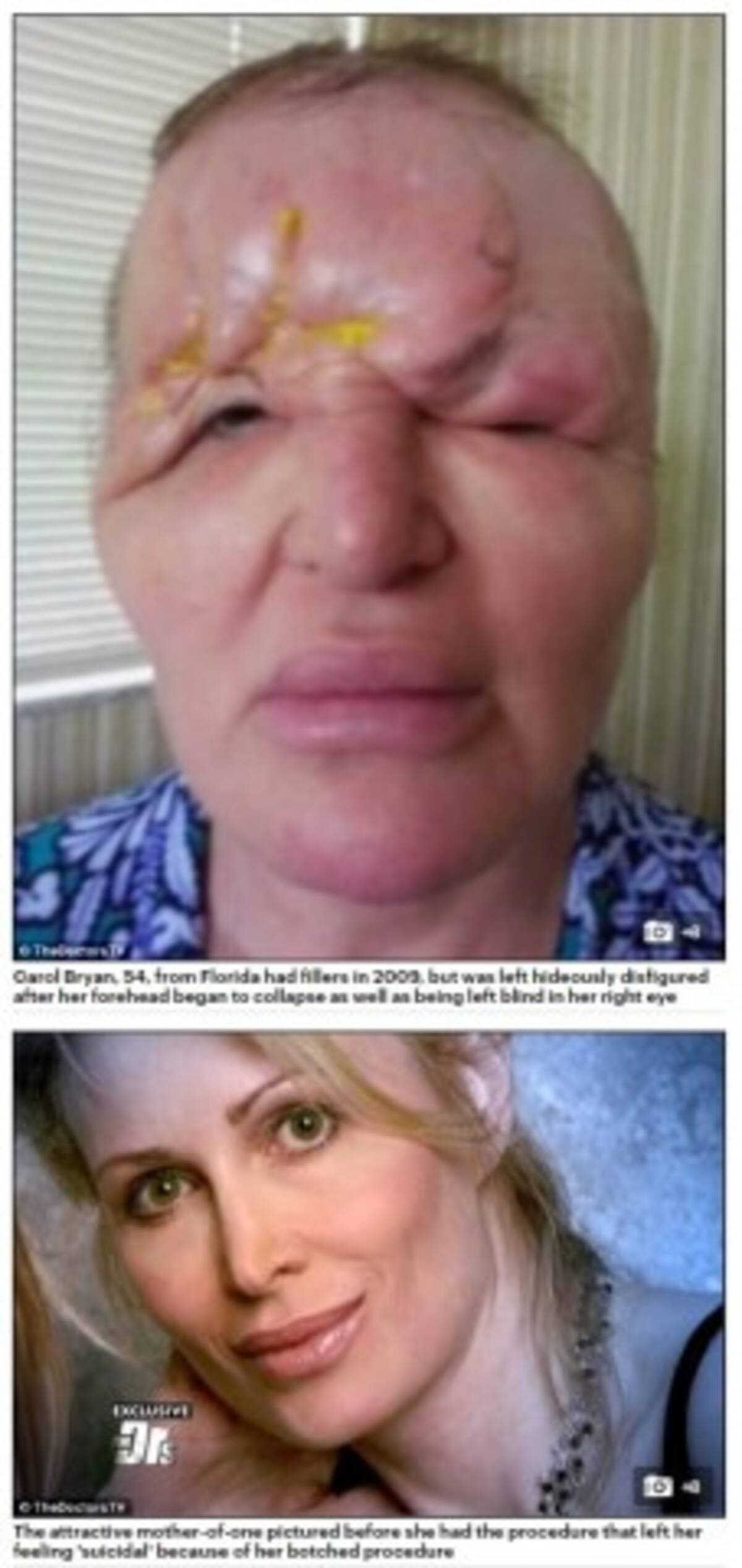まるでエイリアンだった 美容整形手術で顔面が膨張 片目を失明した54歳女性の悲劇 米 17年1月26日 エキサイトニュース