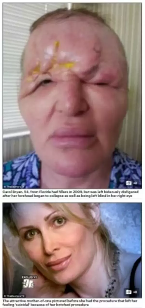 「まるでエイリアンだった」　美容整形手術で顔面が膨張　片目を失明した54歳女性の悲劇（米）