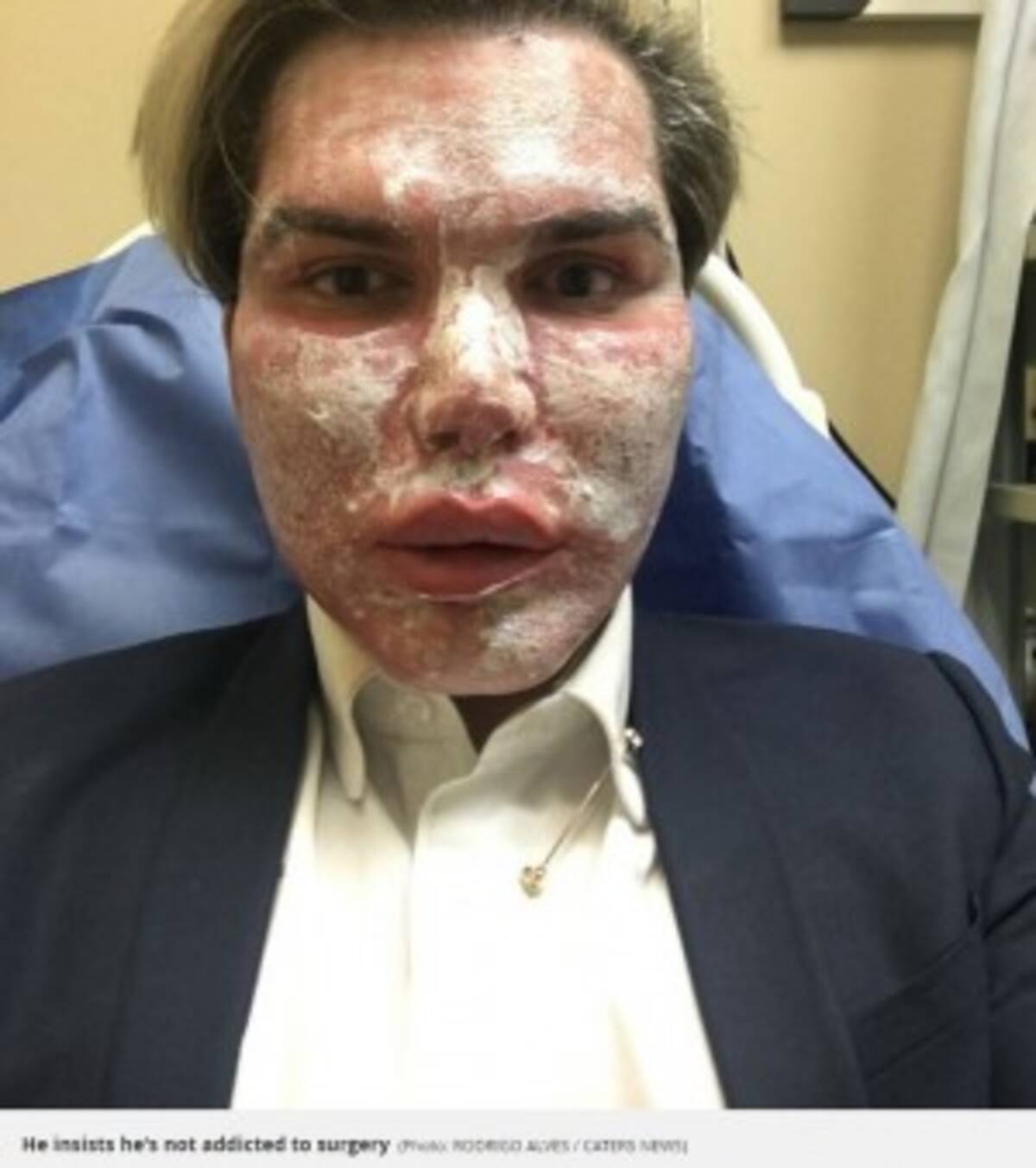 整形51回 リアル ケン が 最も多くの美容整形を受けた男性 でギネス認定か 17年2月27日 エキサイトニュース