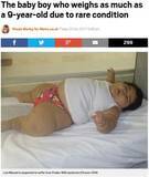 「生後10か月の男の子　過度の体重増加が止まらず30kgに（メキシコ）」の画像1