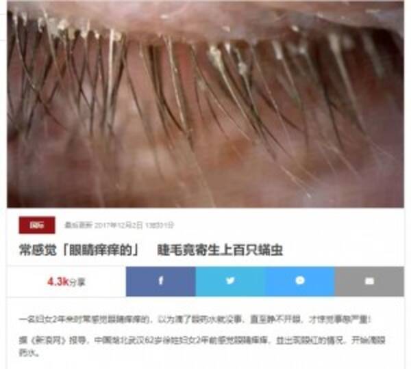 不潔な枕カバー5年使用 開かない瞼の原因は100匹超のまつ毛ダニ 中国 17年12月25日 エキサイトニュース