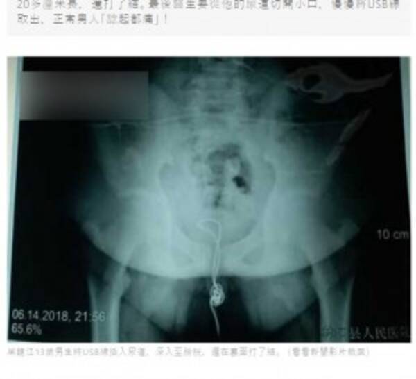 好奇心旺盛な13歳少年 スマホ充電ケーブルを性器に刺し込み病院へ 中国 18年7月10日 エキサイトニュース