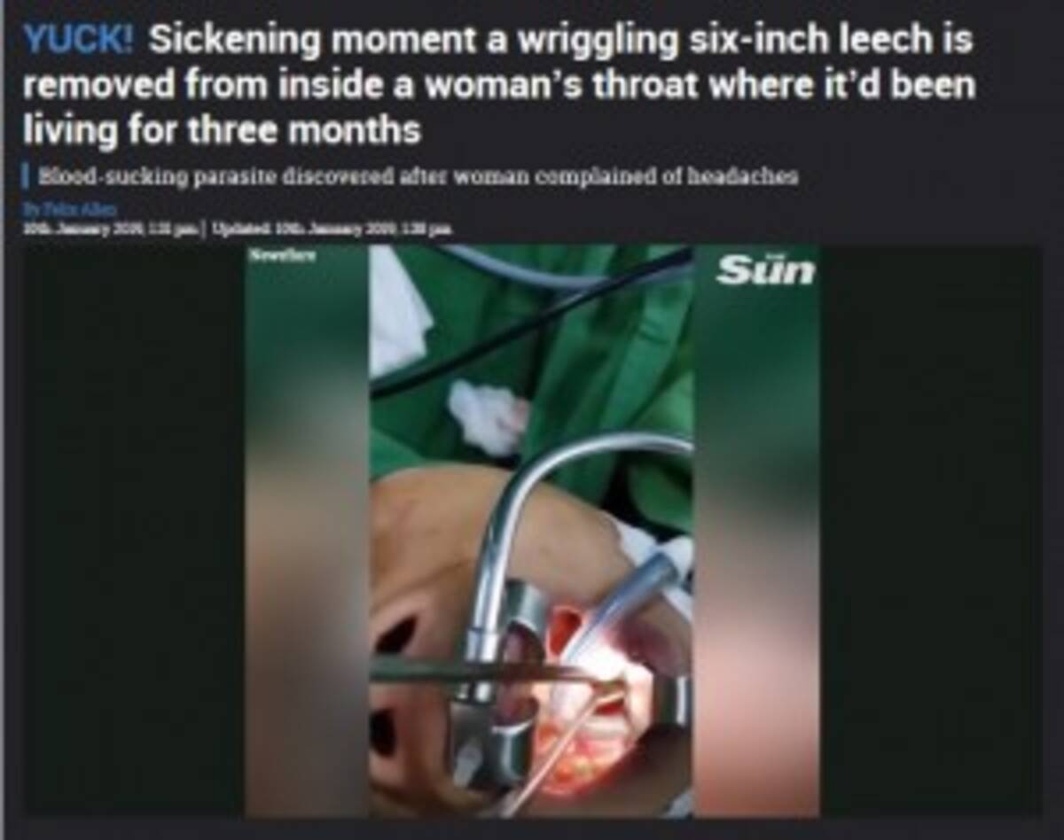 女性の喉から15cmのヒル摘出 体内に3か月間寄生 ベトナム 動画あり 19年1月15日 エキサイトニュース
