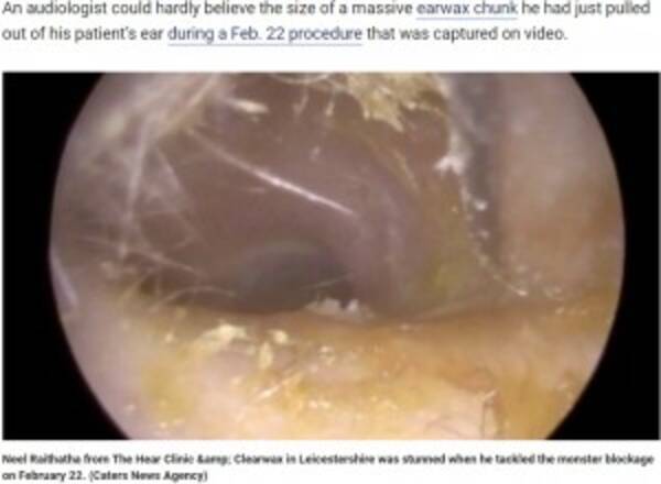 世界一の大きさ 耳を塞ぐ2 5センチの耳垢に医師仰天 英 動画あり 19年7月5日 エキサイトニュース
