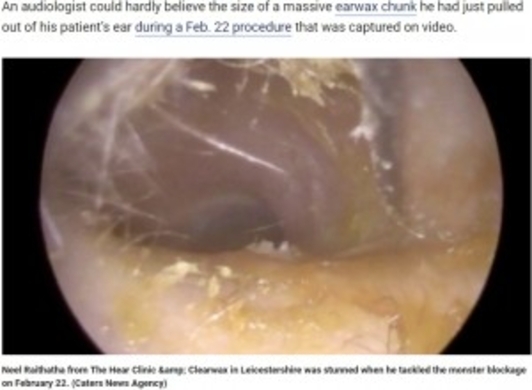 16年間耳掃除をしなかった男性 耳垢の量はこれまでで最高 と除去した専門医 英 動画あり 年9月16日 エキサイトニュース