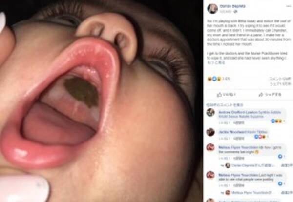 娘の口内に黒い痣のようなものが 母親は心配で涙するも意外な結末 米 19年7月18日 エキサイトニュース