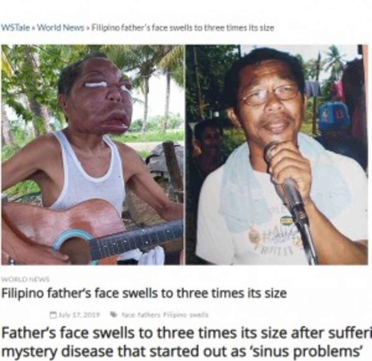 副鼻腔炎と診断されるも原因不明 顔が3倍に腫れ上がってしまったフィリピンの男性 19年7月22日 エキサイトニュース