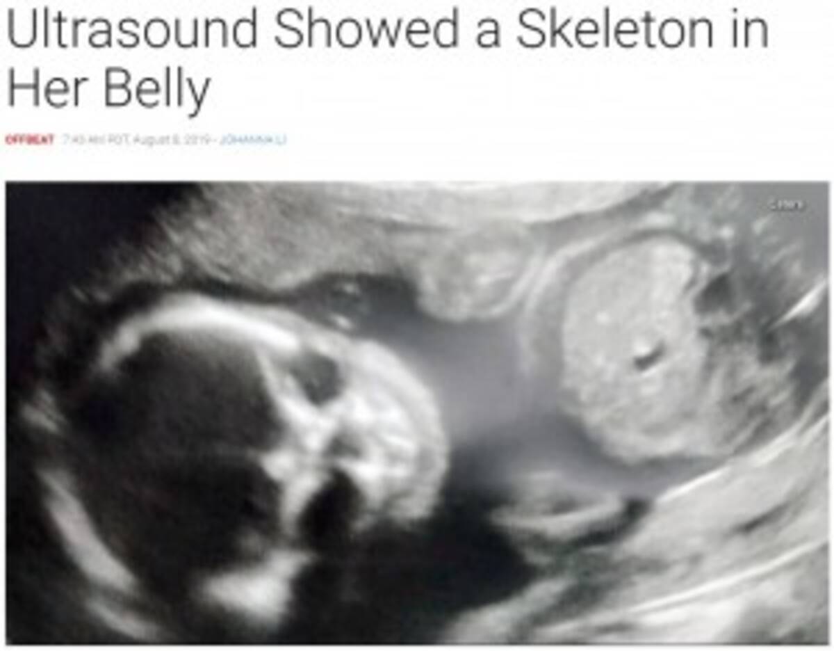 エコー写真に 不気味に笑うドクロ 母親は 出産するまで不安だった 米 19年8月10日 エキサイトニュース
