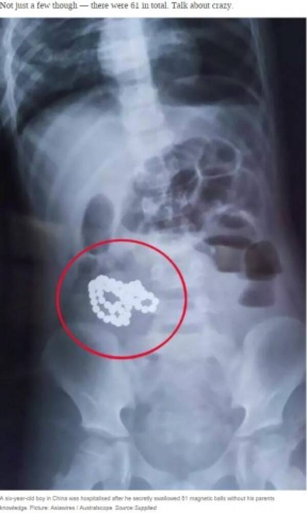 マグネットボール61個を飲み込んだ6歳児 消化管を一部切除 中国 19年8月24日 エキサイトニュース