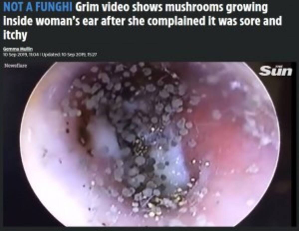 耳の中に無数のキノコに見える真菌が繁殖した女性 ベトナム 動画あり 19年9月22日 エキサイトニュース