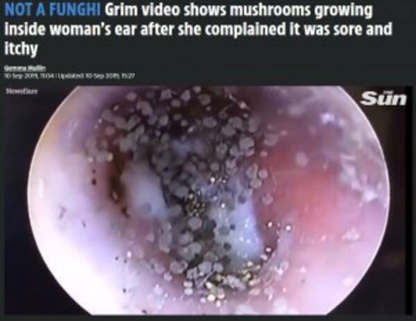 耳の中に無数のキノコに見える真菌が繁殖した女性 ベトナム 動画
