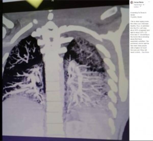 香り付き電子タバコ歴2年の19歳 肺はベーコンの油がべっとり付いた状態 エキサイトニュース