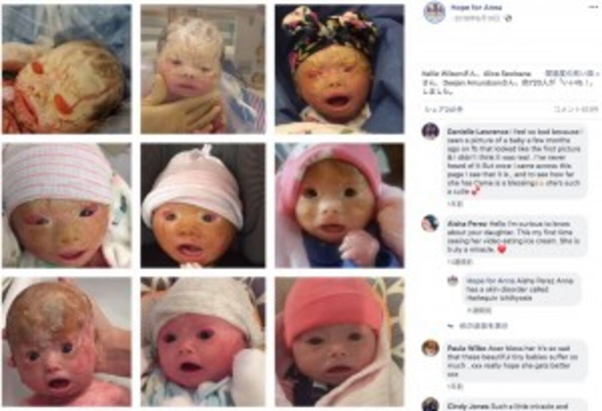 ハーレクイン魚鱗癬の診断