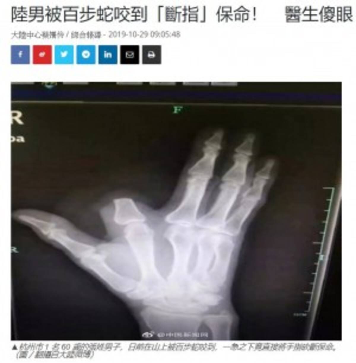 毒ヘビに噛まれた指を慌てて切り落とした男性 その必要はなかった 病院スタッフ 中国 19年11月1日 エキサイトニュース