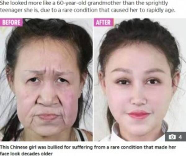 早老症で60代に見える15歳少女 手術で新しい顔を手に入れる 中国 動画あり 年1月24日 エキサイトニュース