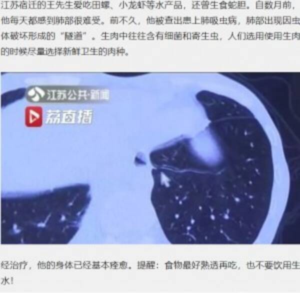 カニ好きの男性 肺に細長い寄生虫が発見される 中国 年5月1日 エキサイトニュース