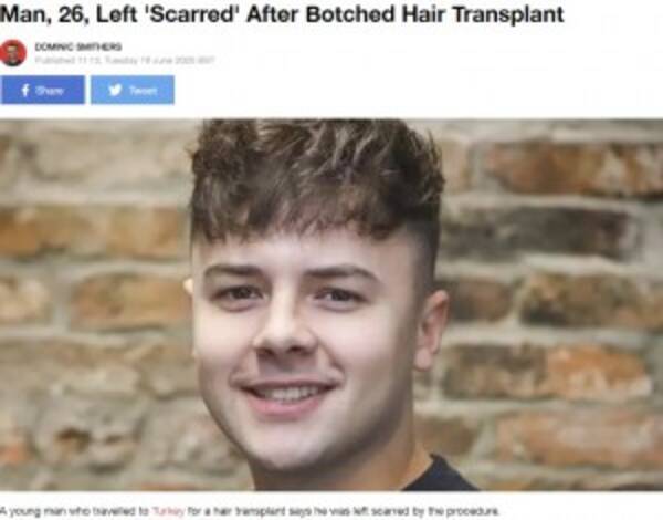 トルコで格安植毛をした26歳男性 禿げと傷痕が痛々しい残念な結果に 英 年6月18日 エキサイトニュース