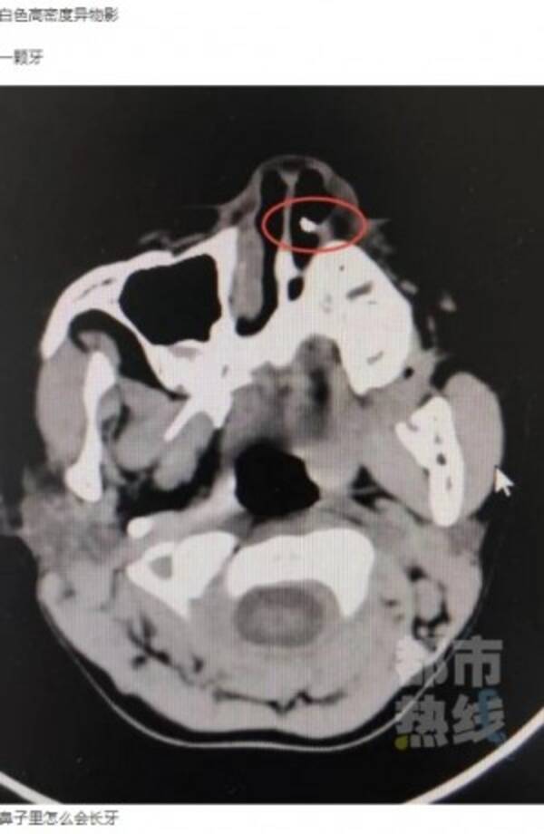 鼻の中に歯が見つかった6歳児 3年前に顔面強打し歯がなくなっていた 中国 年6月28日 エキサイトニュース