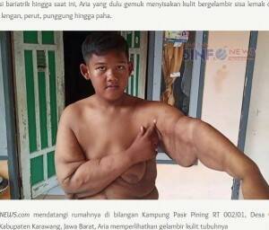 元 世界一の肥満児 腕の皮膚を切除し 過去の自分は恥ずかしくない 前に進むだけ インドネシア 動画あり 年7月2日 エキサイトニュース