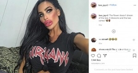 美容整形に780万円かけた31歳女性「次は瞳の色を変えて肋骨を切除したい」（豪）