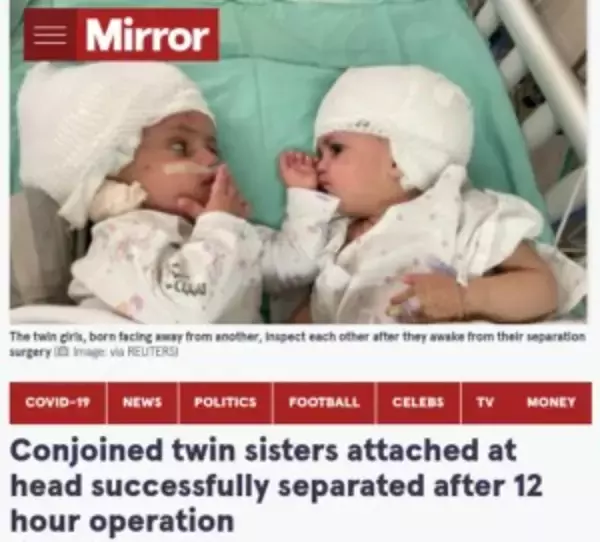 頭部が結合した双子姉妹、分離手術が成功し初めてお互いの顔を見つめ合う（イスラエル）＜動画あり＞