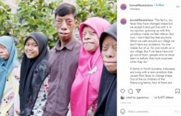 顔が変形し 呪われている と言われる家族 運命を受け入れて前向きに生きる インドネシア 動画あり 21年9月28日 エキサイトニュース