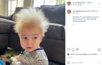 逆立つ髪を持つ「櫛でとかせない頭髪症候群」の1歳男児、母親は「人と違うことはユニークで誇り」（米）