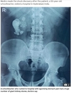 激痛で病院に駆け込んだ男性、腎臓から156個の結石を摘出（印）