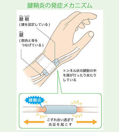 使いすぎ 指の腱鞘炎 バネ指 を改善する２つの方法 年3月19日 エキサイトニュース
