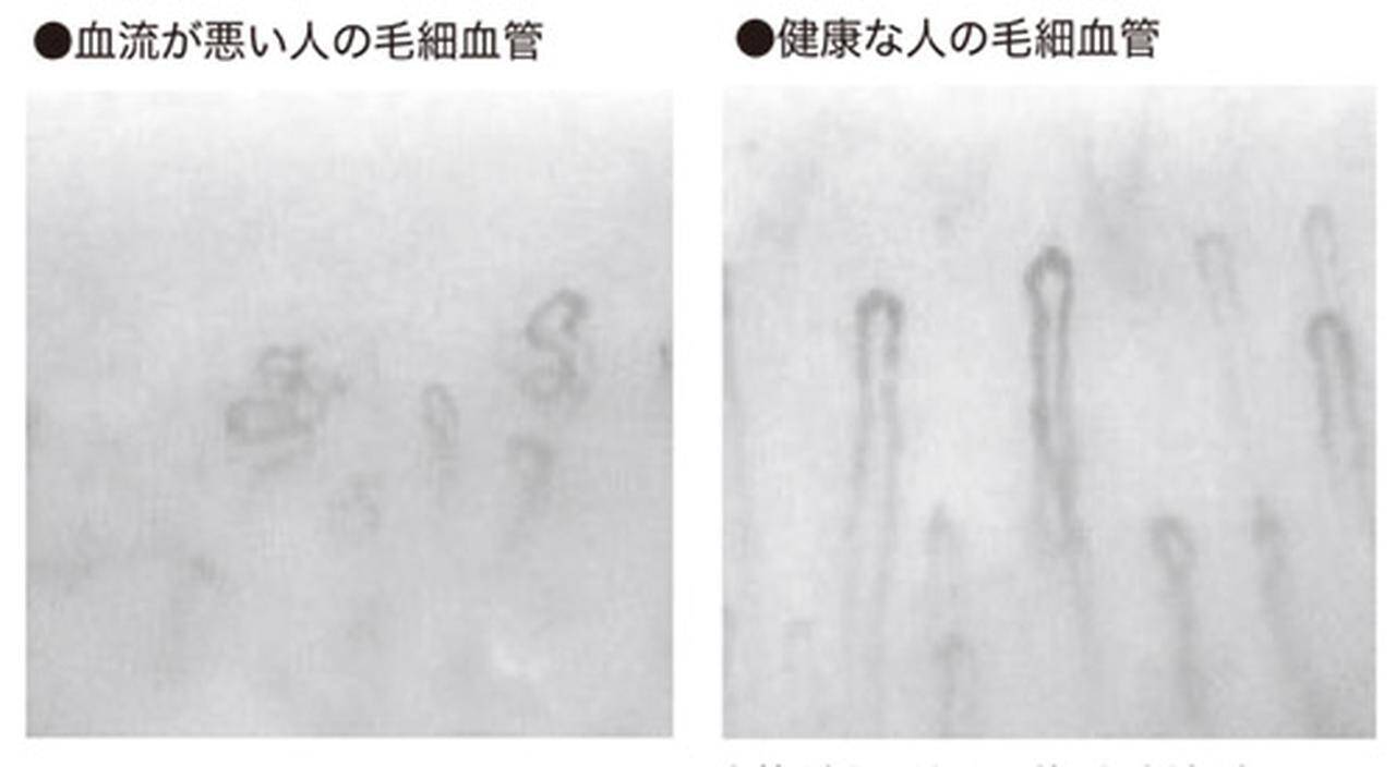 血液が漏れる ゴースト血管って何 改善方法は 19年4月15日 エキサイトニュース 6 8