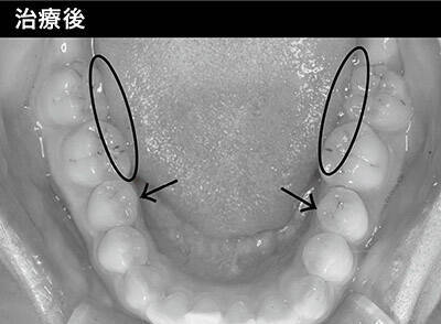 小さい顎に憧れる 舌に歯の跡がつく 不調がある人に注意して欲しいこ 年7月5日 エキサイトニュース 8 9