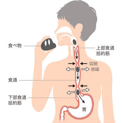 逆流性食道炎 我慢できる 胸やけ でも受診した方がいい理由 年6月30日 エキサイトニュース 2 10