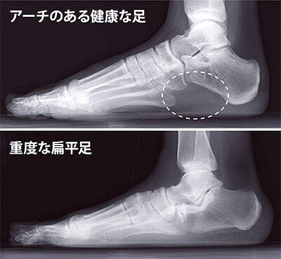 偏平足とは どんな問題が起こる チェック方法は 年1月31日 エキサイトニュース 2 4