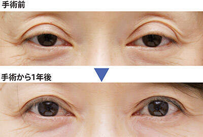 まぶたが下がる 眼瞼下垂の手術は眼科 美容外科 形成外科 年5月27日 エキサイトニュース 3 7